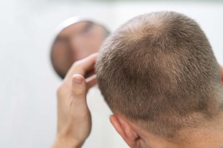 Transplante capilar de última geração: Dr. Stanley Bessa revela como os novos métodos garantem resultados cada vez mais naturais